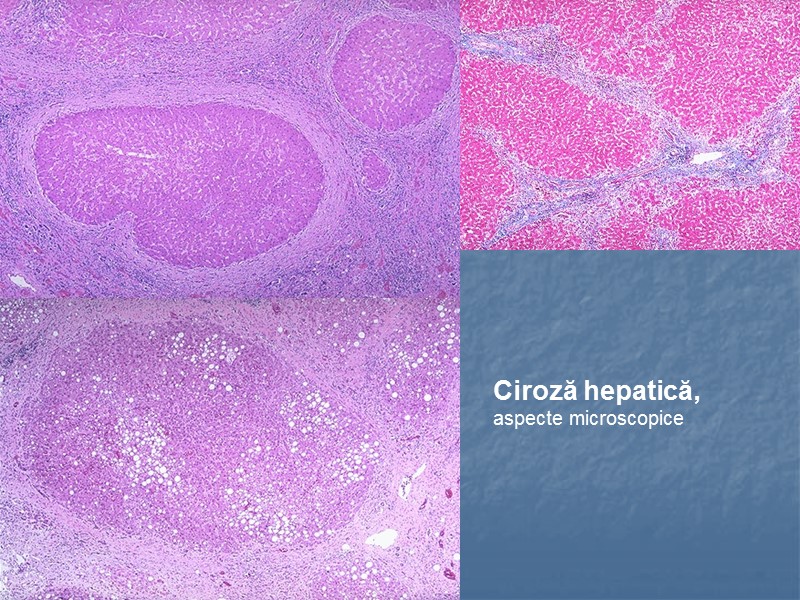 Ciroză hepatică,  aspecte microscopice